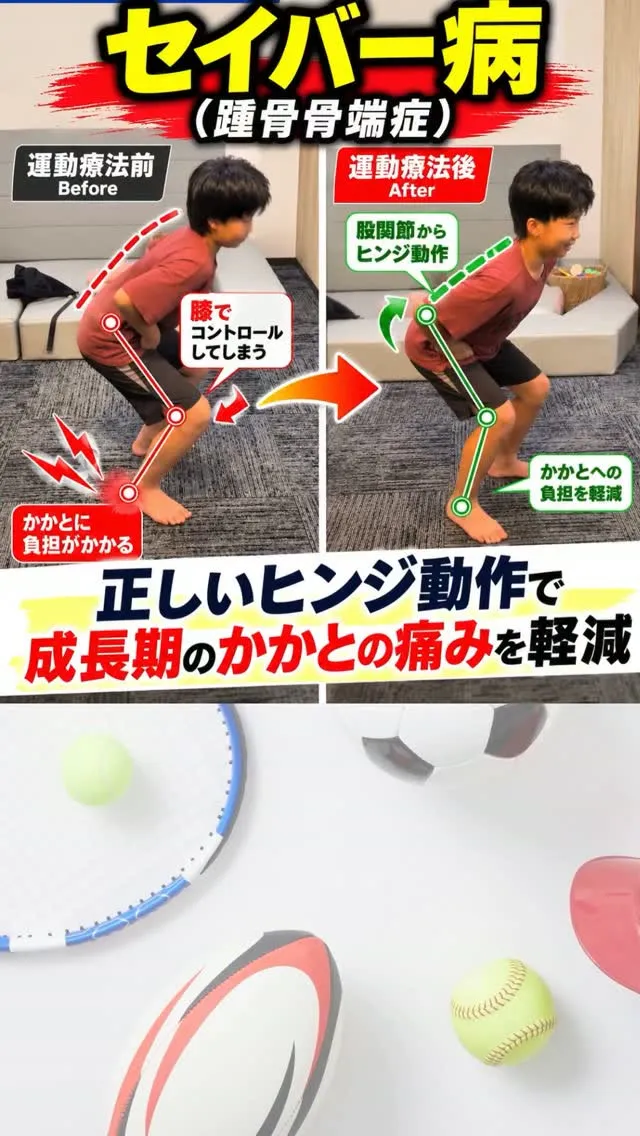 【セイバー病とスクワット動作の関係】